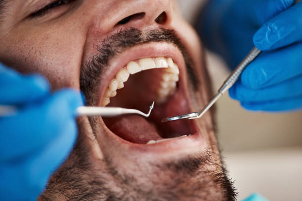 Best Emergency Root Canal Treatment in Edmonston, MD